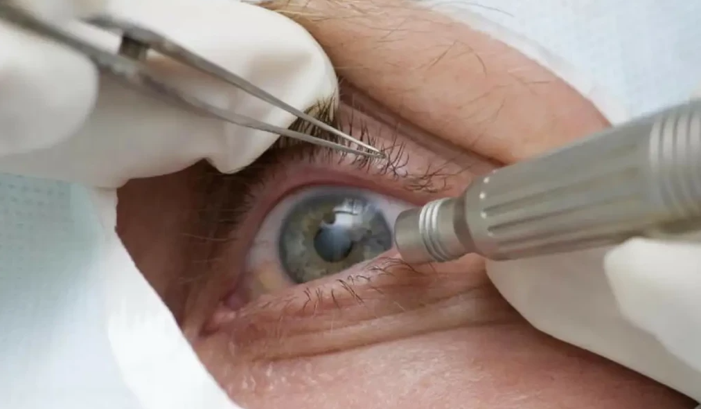 Cirurgia que altera cor do olho tem uso restrito para pessoas cegas